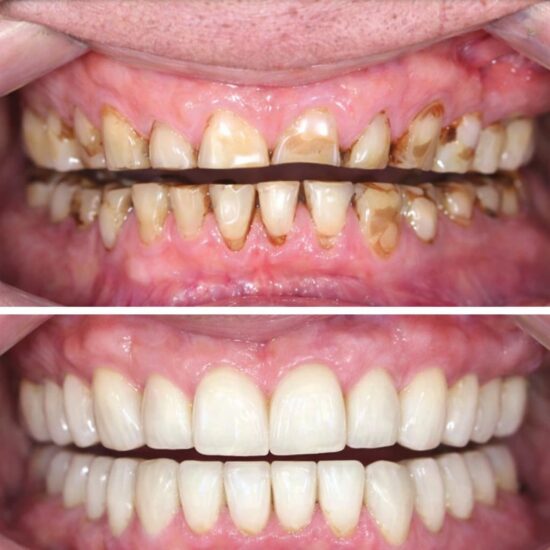 Full Mouth Rehabilitation