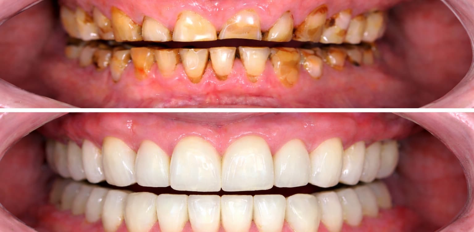 Full Mouth Rehabilitation