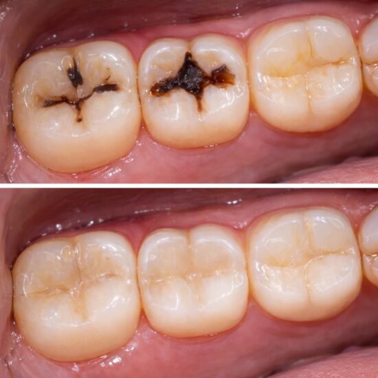 Tooth Coloured restorations