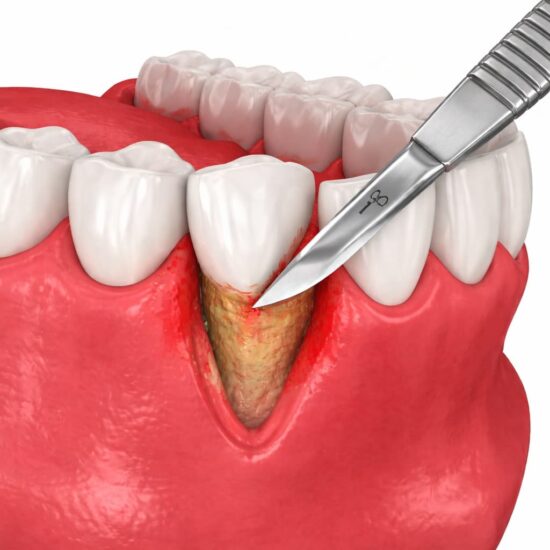 periodontal surgery